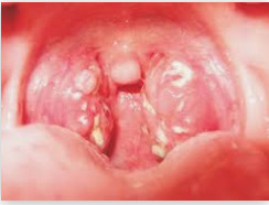 TỔ CHỨC TIÊM CHỦNG ĐẦY ĐỦ VẮC XIN PHÒNG BỆNH BẠCH HẦU CHO CÁC NHÓM ĐỐI TƯỢNG